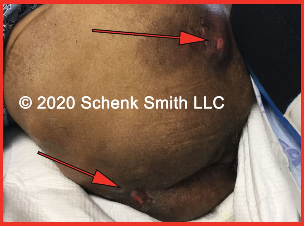Stage-2-Bed-Sore-Buttocks